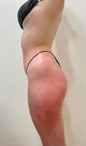 Legs, manual body sculpting (LinfoModellante®), after