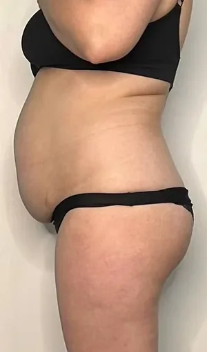 Abdomen, manual body sculpting (LinfoModellante®), before
